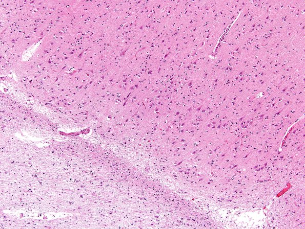 1C3 Hypoxia-Ischemia, OD 15 years vegetative (Case 1) N1 H&E 3