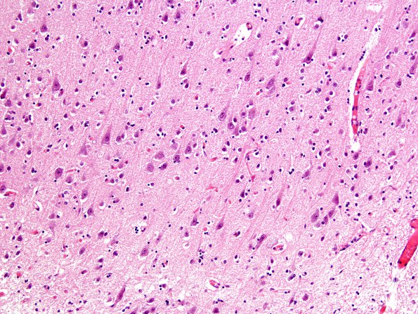 1C4 Hypoxia-Ischemia, OD 15 years vegetative (Case 1) N1 H&E 4