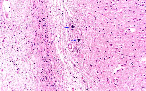 1C5 Hypoxia Ischemia (Persist Veg State, Case 1) N1 20X copy