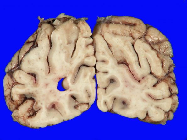 2A1 Hypoxia-Ischemia (Case 2) 7