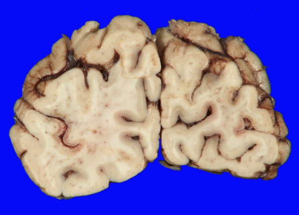 2A3 Hypoxia-Ischemia (Case 2) 8