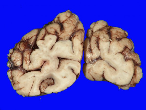 2A5 Hypoxia-Ischemia (Case 2) 11