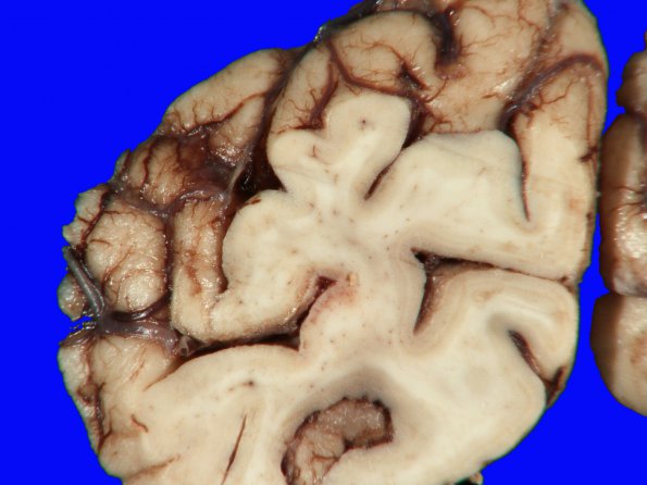 2A6 Hypoxia-Ischemia (Case 2) 12