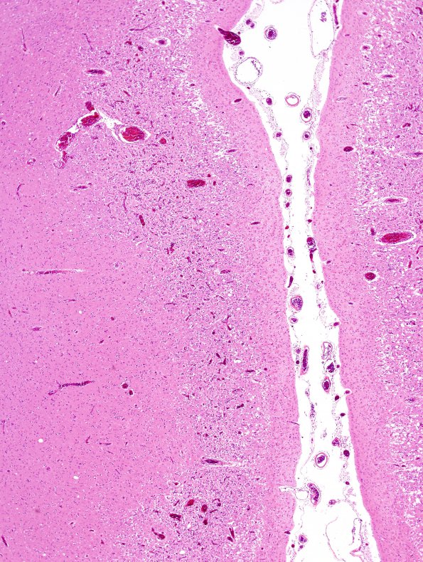 2B2 Hypoxia-ischemia, subacute (Case 2) N12 H&E 4