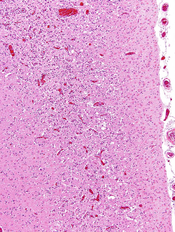 2B3 Hypoxia-ischemia, subacute (Case 2) N12 H&E 3