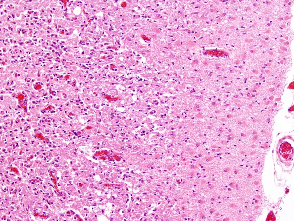 2B4 Hypoxia-ischemia, subacute (Case 2) N12 H&E 2