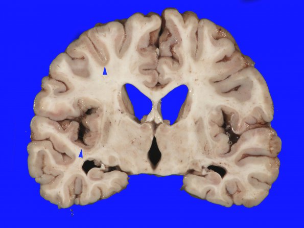 3A Hypoxia-Ischemia (Case 3) 4 copy