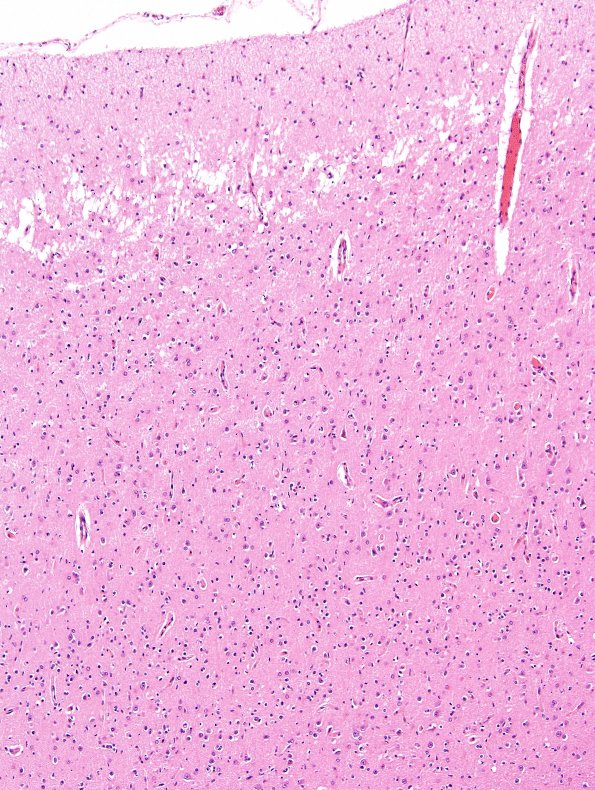 3B1 Hypoxia-Ischemia (Case 3) Microglia, temporal cortex H&E 1