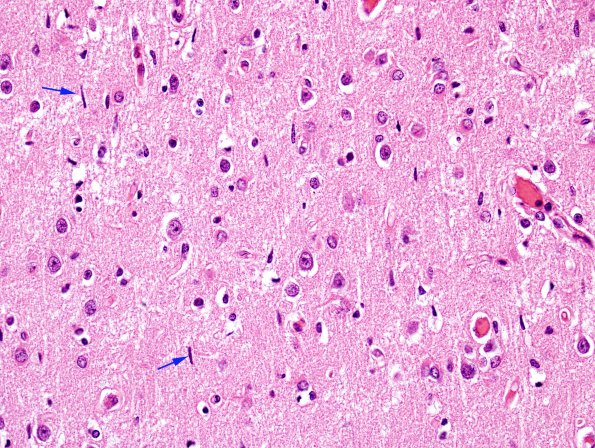 3B2 Hypoxia-Ischemia (Case 3) Microglia, temporal cortex H&E 2 copy