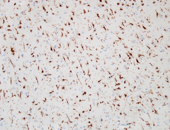 3C1 Hypoxia-Ischemia (Case 3) Microglia, temporal cortex CD68 14