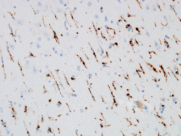 3C2 Hypoxia-Ischemia (Case 3) Microglia, temporal cortex CD68 15