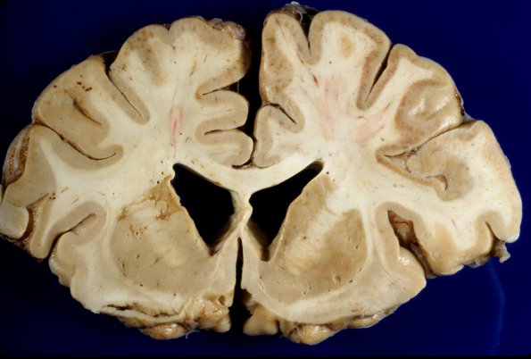 4A1 Hypoxia-Ischemia, Laminar Necrosis (Case 4) 2