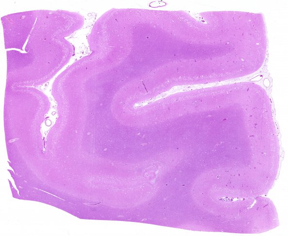 4B1 Hypoxia-Ischemia, Laminar Necrosis (Case 4) H&E whole mount