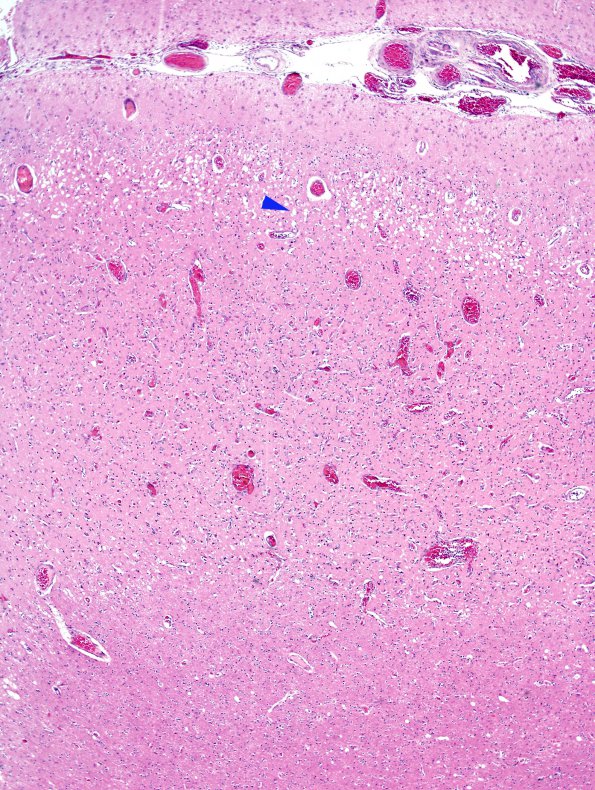 4B2 Hypoxia-Ischemia, Laminar Necrosis (Case 4) H&E 1B copy