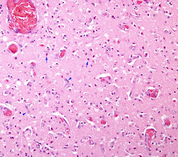 4B3 Hypoxia-Ischemia, Laminar Necrosis (Case 4) H&E 1A copy