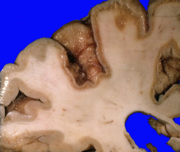 5A1 Hypoxia-Ischemia (Case 5) 1