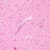 6A1 Hypoxia-Ischemia, 3-4 days, cerebral cortex (Case 6) H&E 2