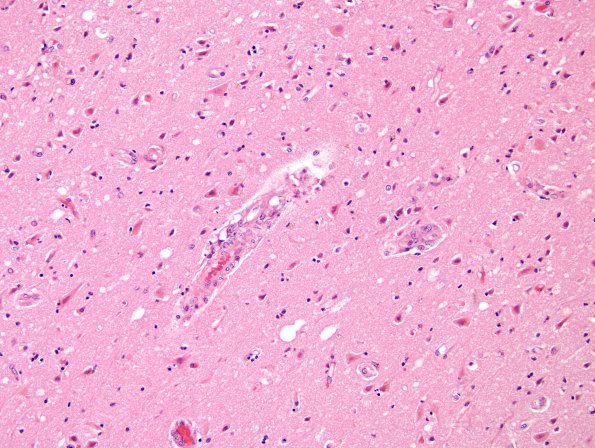 6A1 Hypoxia-Ischemia, 3-4 days, cerebral cortex (Case 6) H&E 2