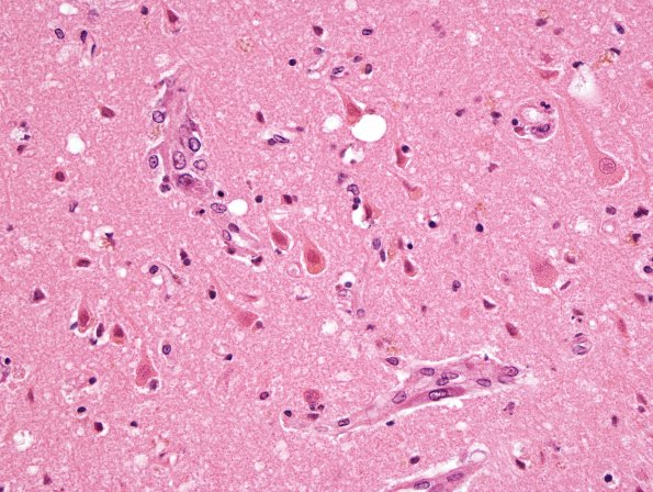 6A2 Hypoxia-Ischemia, 3-4 days, cerebral cortex (Case 6) H&E 1