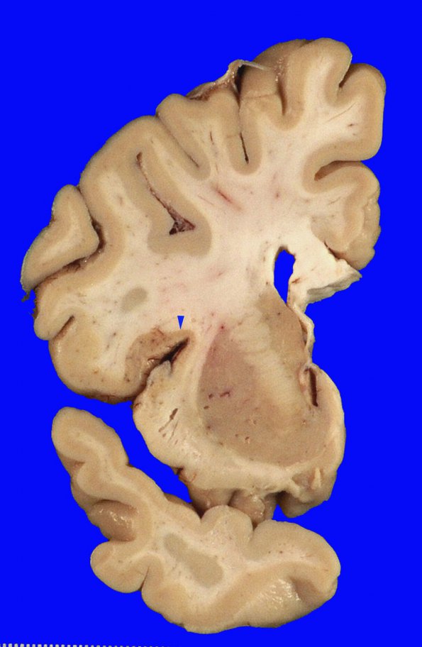 7A1 Hypoxia-Ischemia, depth of sulcus (Case 7)_1 copy A