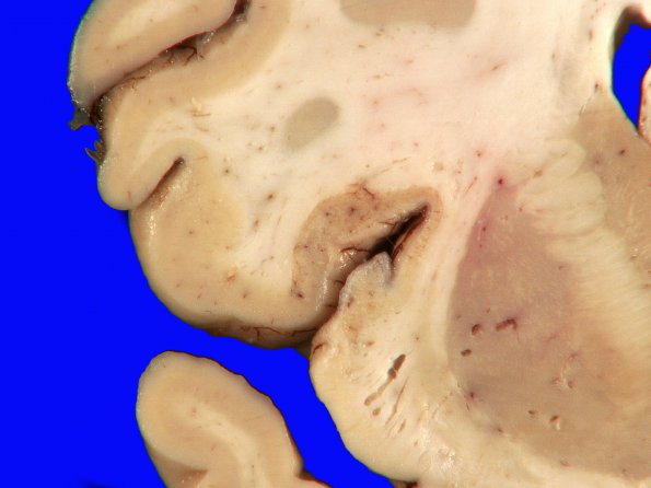 7A2 Hypoxia-Ischemia, depth of sulcus (Case 7)_2