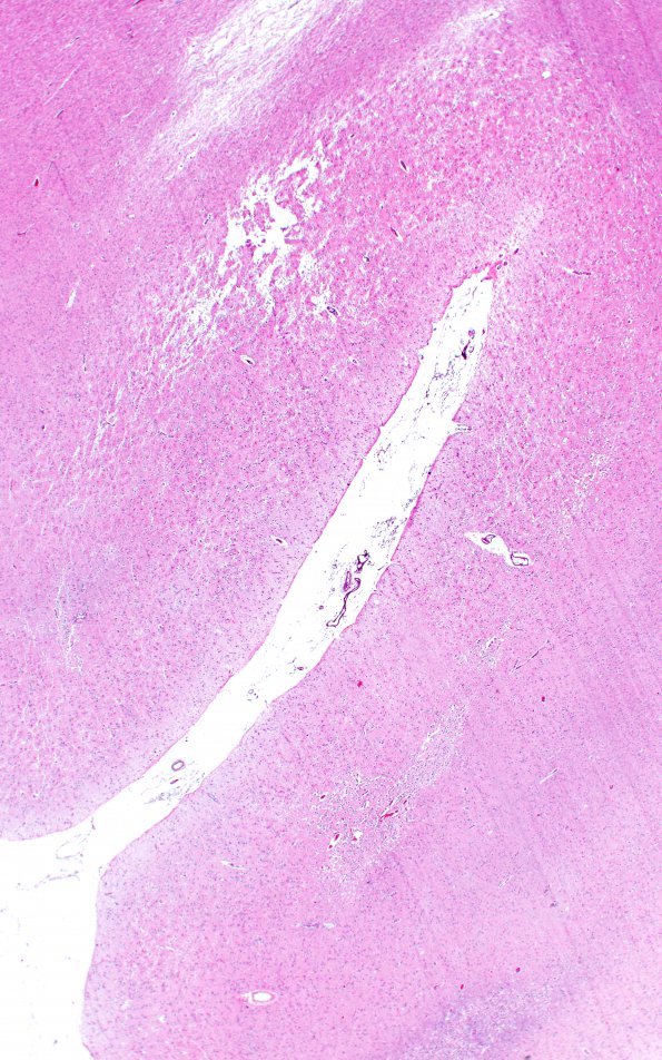 7B2 Hypoxia-Ischemia, depth of sulcus (Case 7) 33 2X