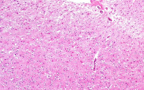 7B3 Hypoxia-Ischemia, depth of sulcus (Case 7) 33 10X