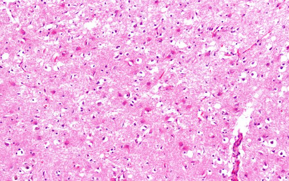 7B4 Hypoxia-Ischemia, depth of sulcus (Case 7) 33 20X 2