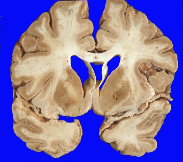 8A1 Hypoxia-Ischemia, laminar necrosis (Case 8) 3