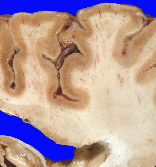 8A2 Hypoxia-Ischemia, laminar necrosis (Case 8) 1