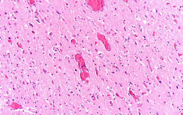 8B1 Hypoxia-Ischemia, laminar necrosis (Case 8) N3b H&E 20X