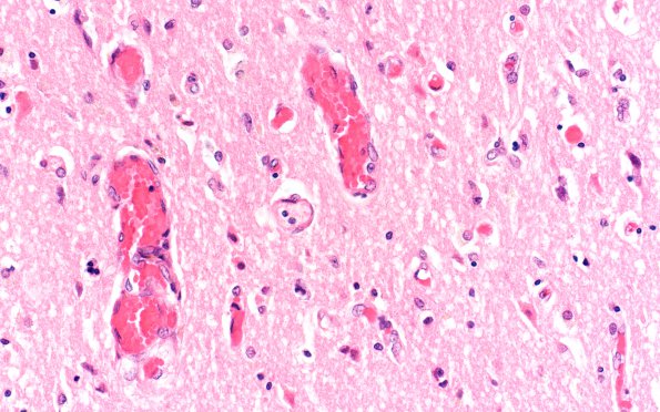 8B2 Hypoxia-Ischemia, laminar necrosis (Case 8) N3b H&E 40X