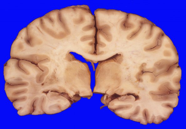 9A Hypoxia-Ischemia, global (Case 9) 2