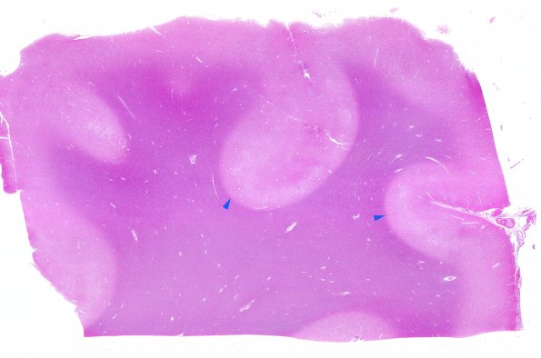 9B1 Hypoxia-Ischemia, global (Case 9) N1 H&E WM copy