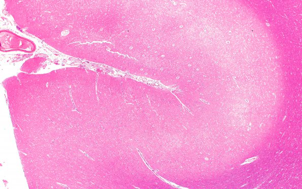 9B2 Hypoxia-Ischemia, global (Case 9) N1 H&E 2X