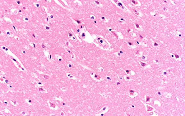 9B3 Hypoxia-Ischemia, global (Case 9) N1 H&E 40X sulcal depth