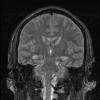 1A2 Hypoxia-Ischemia (Case 1) FLAIR - Copy