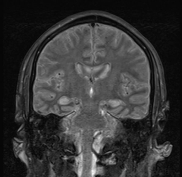 1A2 Hypoxia-Ischemia (Case 1) FLAIR - Copy