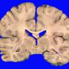 1B2 Hypoxia-Ischemia (Case 1) 2