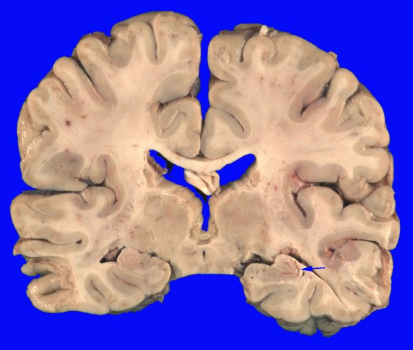 1B2 Hypoxia-Ischemia (Case 1) 2