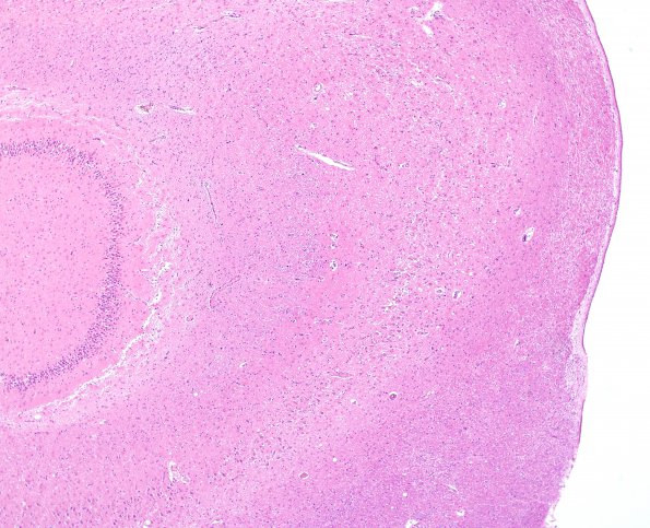 1C2 Hypoxia-Ischemia (Case 1) H&E N13 4X