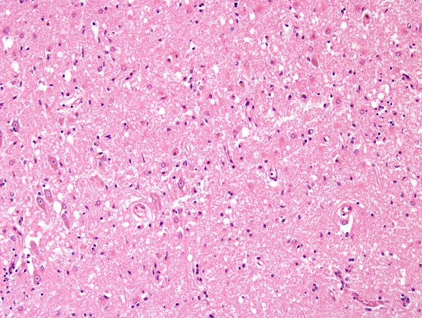 1C3 Hypoxia-Ischemia (Case 1) H&E N13 5