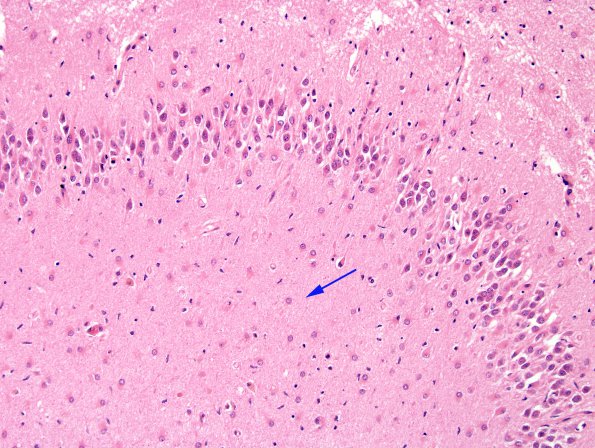 1C4 Hypoxia-Ischemia (Case 1) H&E N13 2 copy