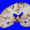 3A Infarct, Watershed (Case 3) 12 copy