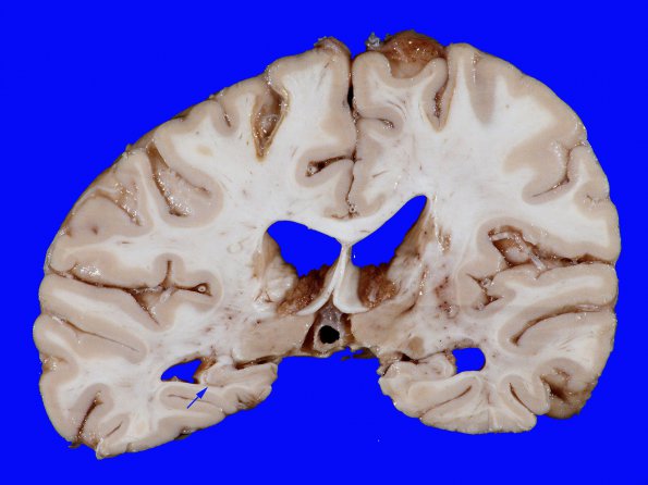 3A Infarct, Watershed (Case 3) 12 copy