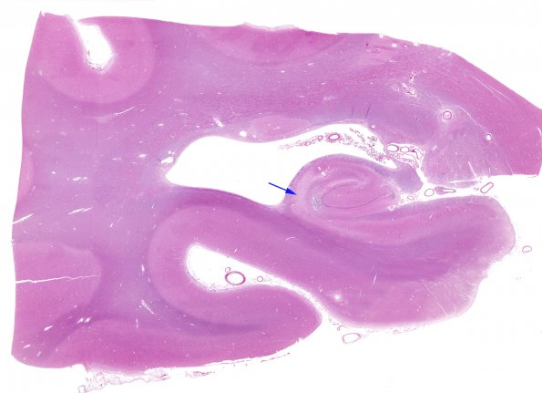 3B1 Hypoxia-Ischemia, Sommer's (Case 3) H&E WM copy