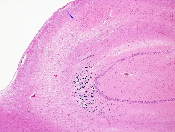 3B2 Hypoxia-Ischemia, Sommer's (Case 3) H&E 4 copy