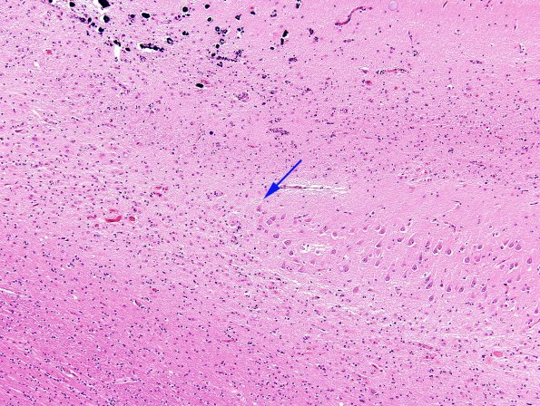 3B3 Hypoxia-Ischemia, Sommer's (Case 3) H&E 3 copy