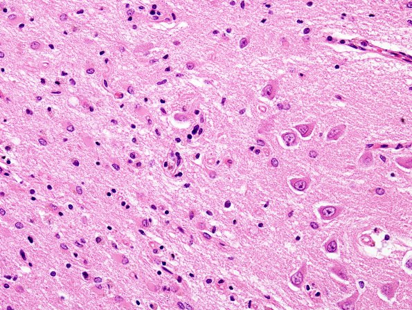 3B4 Hypoxia-Ischemia, Sommer's (Case 3) H&E 1