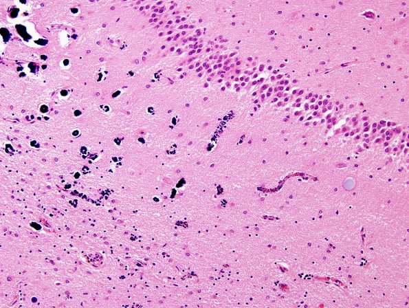 3B5 Hypoxia-Ischemia, Sommer's (Case 3) H&E 5